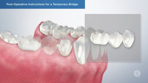 Post-Operative Instructions for a Temporary Bridge