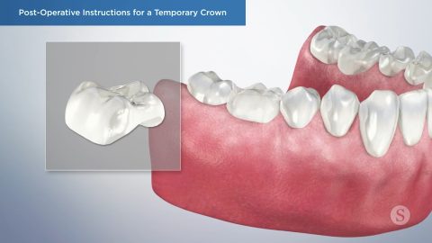 Post-Operative Instructions for a Temporary Crown