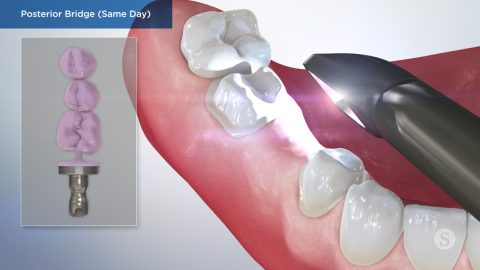 Posterior Bridge (Same Day)