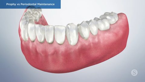 Prophy vs Periodontal Maintenance