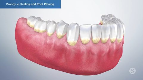 Prophy vs Scaling and Root Planing