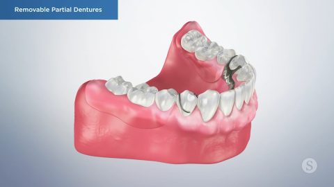 Removable Partial Dentures