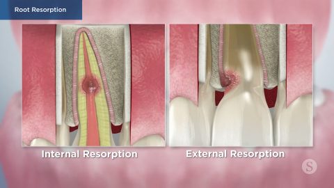 Root Resorption