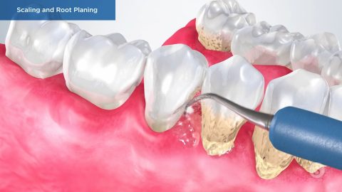 Scaling and Root Planing