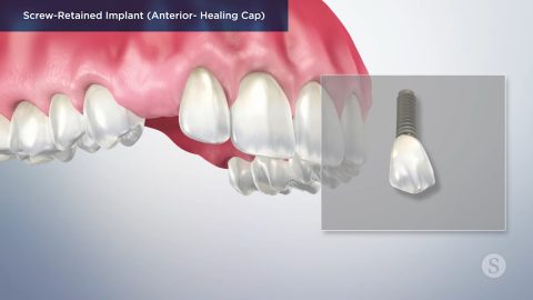 Screw-Retained Implant (Anterior- Healing Cap)