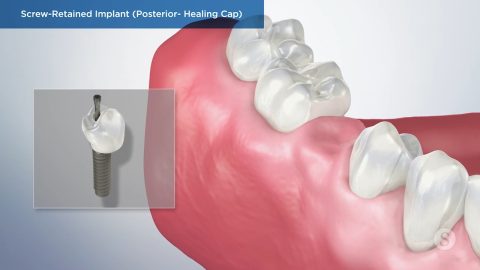 Screw-Retained Implant (Posterior- Healing Cap)