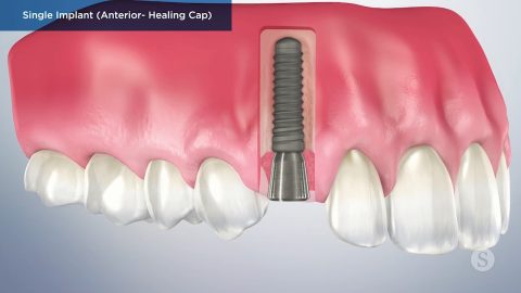 Single Implant (Anterior- Healing Cap)