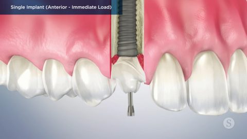 Single Implant (Anterior- Immediate Load)