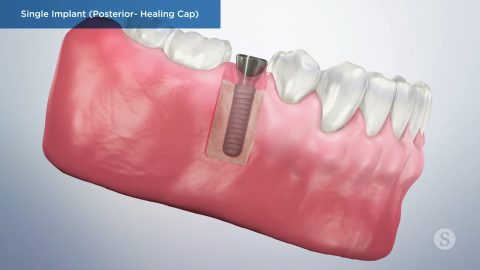 Single Implant (Posterior- Healing Cap)