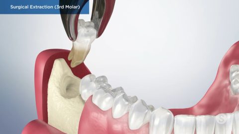 Surgical Extraction (3rd Molar)