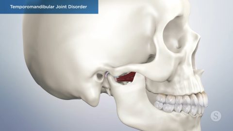 Temporomandibular Joint Disorder