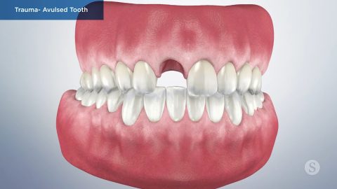 Trauma- Avulsed Tooth