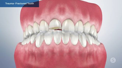 Trauma- Fractured Tooth