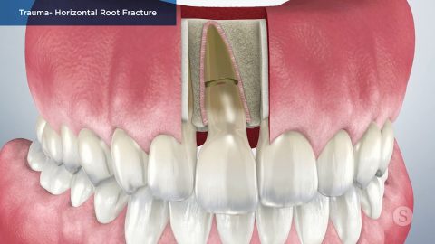 Trauma- Horizontal Root Fracture