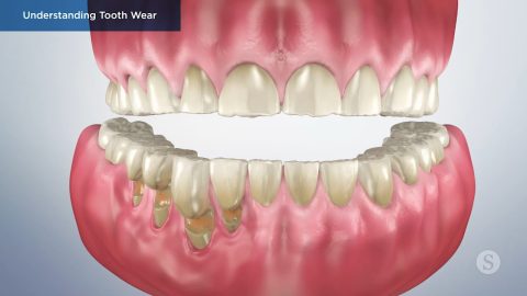 Understanding Tooth Wear