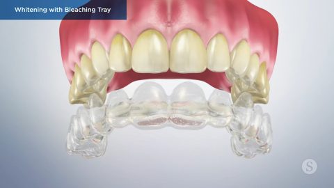 Whitening with Bleaching Tray